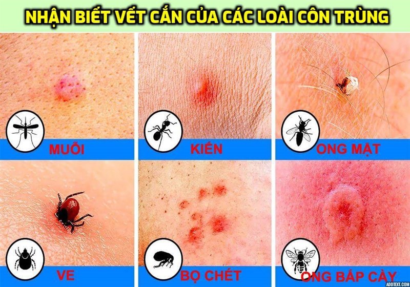 Phân biệt vết cắn của côn trùng để xử trí đúng cách