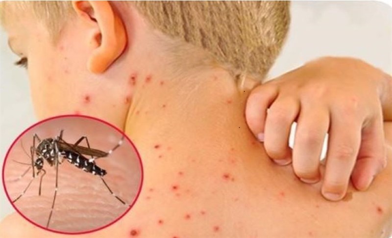 Theo dõi và chăm sóc trẻ Sốt xuất huyết